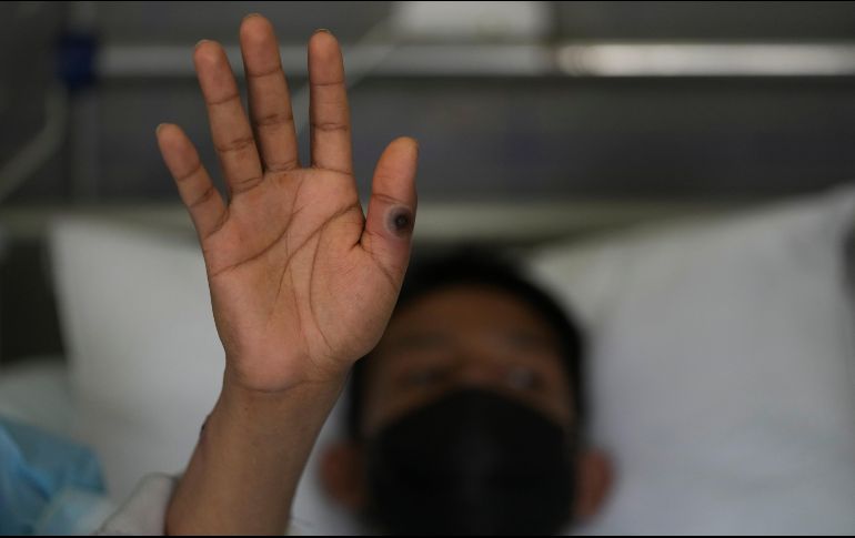 Los pacientes contagiados por la viruela del mono tienen registro de haber salido del estado. ARCHIVO/ SUN
