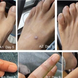 Se registran 10 casos de viruela del mono cada semana en Jalisco