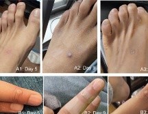 Los infectados de viruela del mono reportaron como primer síntoma lesiones en la piel y/o mucosas. ESPECIAL