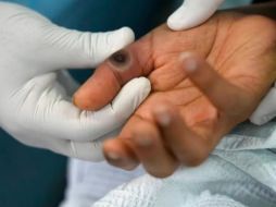 En Yucatán, 20 de los 59 pacientes reportados en la entidad con viruela del mono ya fueron dados de alta. ESPECIAL