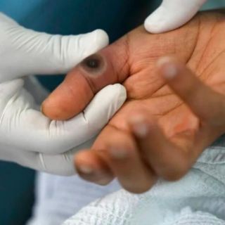 En Yucatán dan de alta a 20 de los 59 pacientes con viruela símica