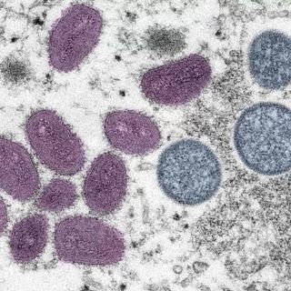 Jalisco roza las dos centenas de infectados de viruela del mono