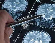 La investigación sobre la enfermedad de Alzheimer está mejorando las perspectivas de los pacientes con demencia en todo el mundo. GETTY IMAGES