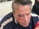 Los golpes que recibió Adame le provocaron cuatro fracturas en varias partes de cara, la más grave la de su ojo derecho. ESPECIAL