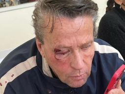 Adame fue intervenido en el hospital general Dr. Gea González por las cuatro fracturas en su rostro, así como las lesiones que tenía en el ojo derecho luego de que fuera agredido en la alcaldía Tlalpan de la Ciudad de México. ESPECIAL