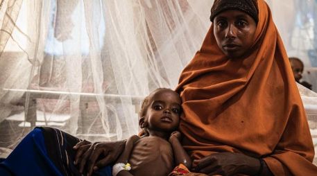 Muchos niños tienen graves problemas de salud debido a la falta de alimentos en Somalia. GETTY IMAGES