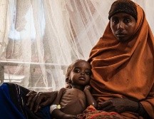 Muchos niños tienen graves problemas de salud debido a la falta de alimentos en Somalia. GETTY IMAGES