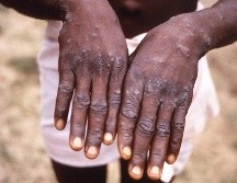 Según expertos, la disminución de la epidemia se debe en gran medida al cambio de comportamiento en las comunidades de riesgo, aunque la inmunización también desempeñó un papel importante. AP / ARCHIVO