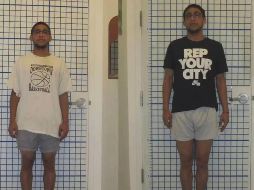 Sam se sometió a una operación que le ayudó a ganar unos centímetros. DR S. ROBERT ROZBRUCH