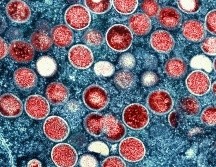 Argentina reportó 895 casos confirmados de mpox este lunes. AP/ARCHIVO