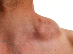 La enfermedad del linfoma de Hodgkin. ESPECIAL