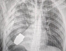 Una radiografía muestra lo cerca que se econtraba la granada del corazón del soldado ucraniano. Hanna Maliar Facebook