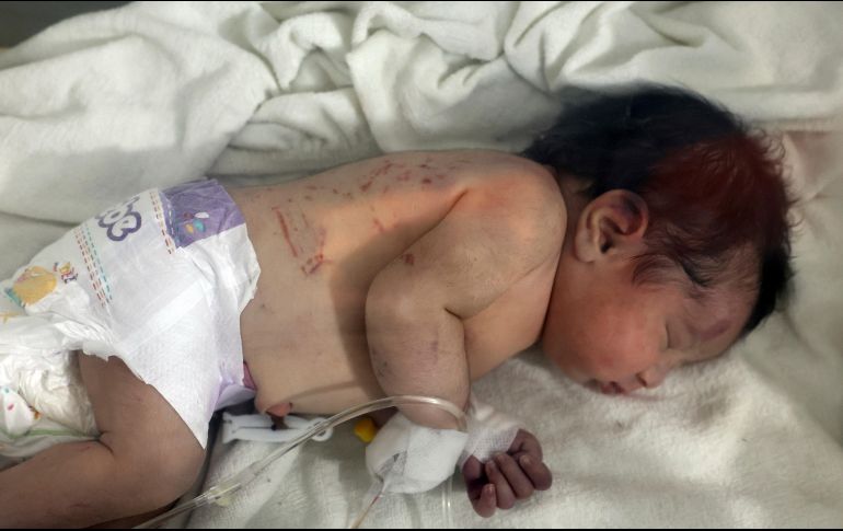 La bebé fue trasladada a Afrín, donde permanece desde entonces recibiendo tratamiento médico. AP/ARCHIVO