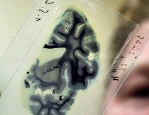 Resaltan la importancia del diagnóstico, y el medicamento que, para cada caso es distinto, personal y no debe interrumpirse, a fin de evitar que aumenten las crisis epilépticas. EFE / ARCHIVO