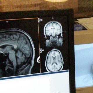 Reportan más enfermos de Parkinson en Jalisco