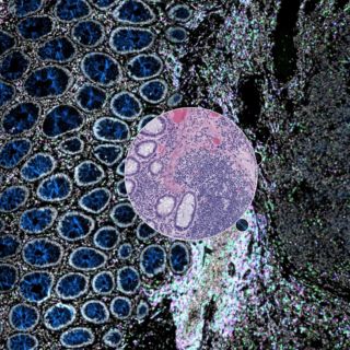 Crean nueva herramienta para diagnosticar el cáncer