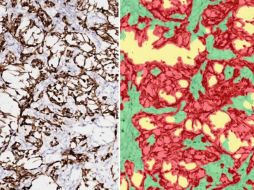 Dos imágenes de tumores de ratón. Los segmentos rojos de la derecha son células cancerosas. EFE/ Imagen cedida por Laboratorio Janowitz/Laboratorio Cold Spring Harbor