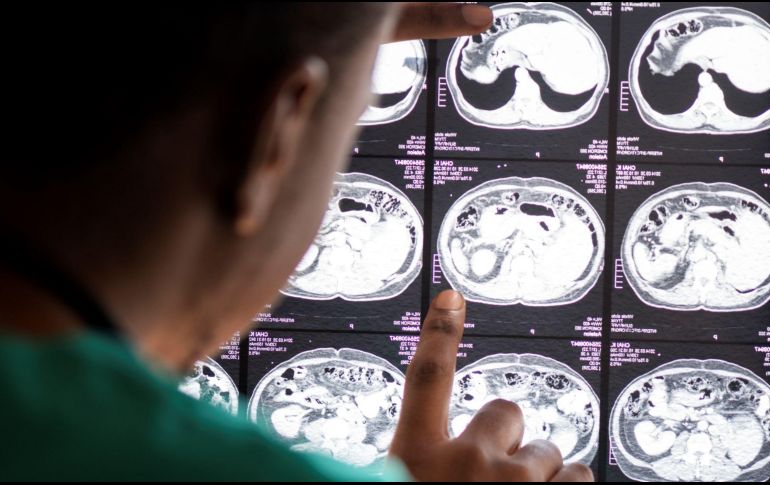 50 millones de personas padecen demencia en el mundo. De ellos, el 60/70 por ciento son casos de Alzheimer. ESPECIAL/ Freepik