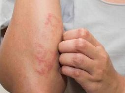 Actualmente hay 300  casos de lepra confirmados en distintos estados de México, por lo que la Secretaría de Salud se mantiene en alerta vigilando a los estados afectados./ Unplash