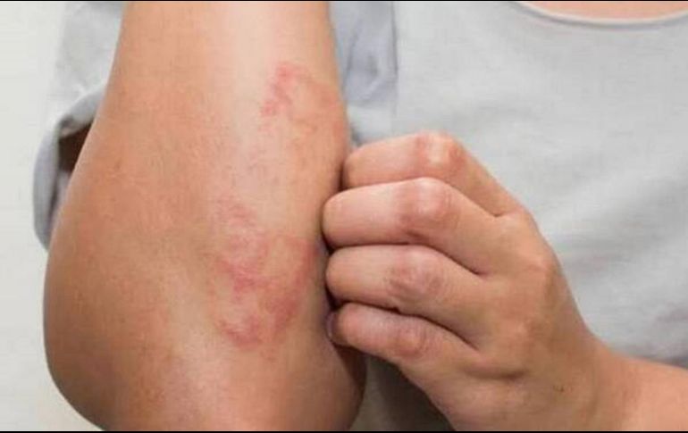 Actualmente hay 300  casos de lepra confirmados en distintos estados de México, por lo que la Secretaría de Salud se mantiene en alerta vigilando a los estados afectados./ Unplash