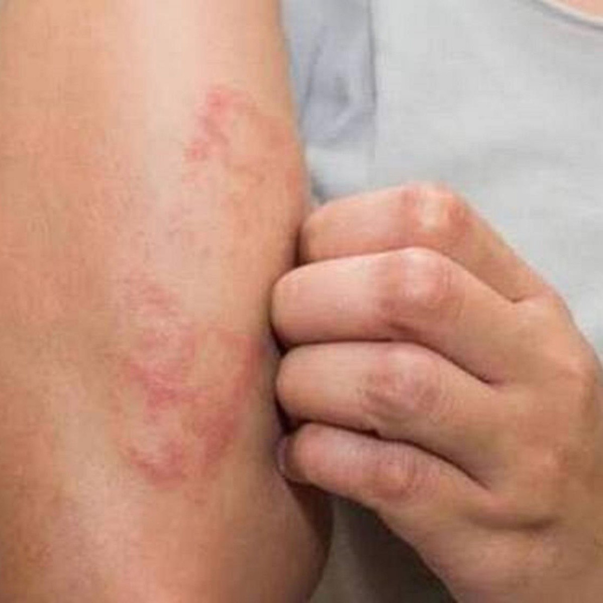 síntomas y signos de la lepra