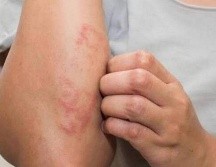 Actualmente hay 300  casos de lepra confirmados en distintos estados de México, por lo que la Secretaría de Salud se mantiene en alerta vigilando a los estados afectados./ Unplash