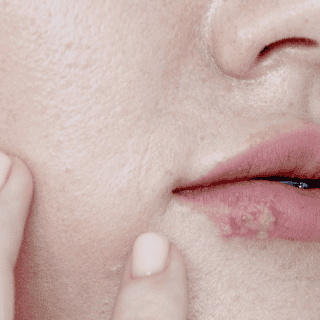 ¿Qué es el herpes labial y por qué sale?