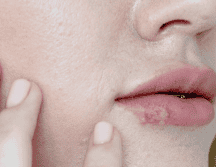 No existe una cura para el herpes labial. ESPECIAL / Prexels
