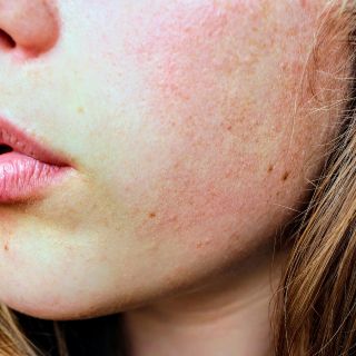 Dermatitis atópica: ¿Se transmite de padres a hijos, cuáles son sus síntomas?