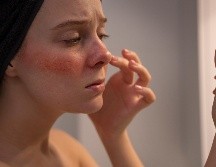 Es una de las enfermedades cutáneas más prevalentes en el mundo y la que tiene poco reconocimiento. ESPECIAL/ Freepik