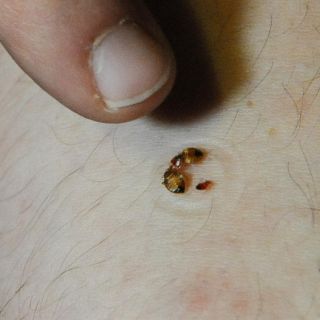 ¿Qué enfermedades ocasionan las chinches?