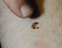 De acuerdo con información de Mayo Clinic las heridas sanan solas en el lapso de una y dos semanas.AFP/Archivo