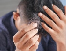 Si se te está empezando a caer el cabello checa cuál es la mejor vitamina para evitar este proceso. Unsplash.