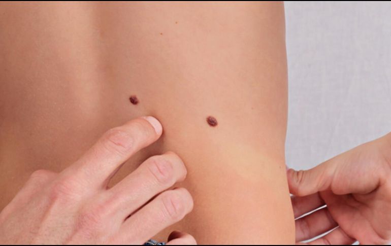 Los lunares aparecen por lo general como pequeños puntos marrones u oscuros, y son causados por grupos de células que producen la pigmentación. ESPECIAL/ UNSPLASH
