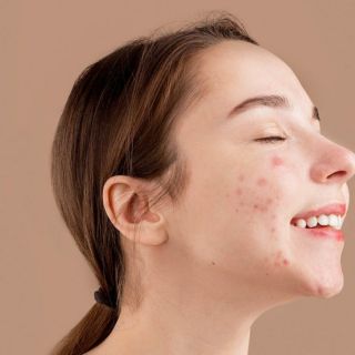 ¿Cómo evitar que el uso del celular provoque acné?