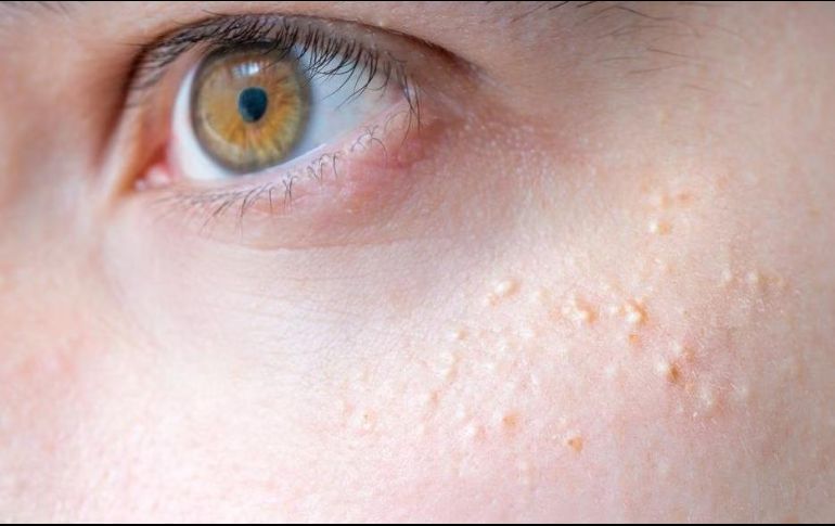 El acné es una afectación que millones de personas poseen. SUN/ARCHIVO