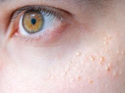 Este problema de piel no produce dolor. SUN/ARCHIVO