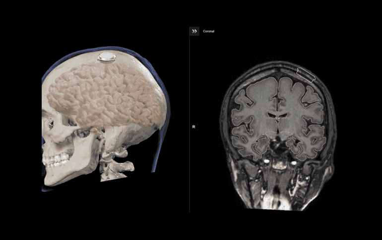 De acuerdo con el CEO de Neuralink, la compañía busca brindar la oportunidad a los pacientes de mover el mouse en varias direcciones. ESPECIAL / NEURALINK