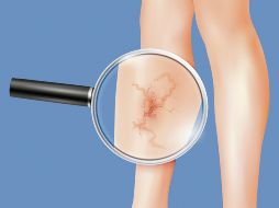 Las várices presentan un tono morado o azulado debido a la acumulación de sangre en estos conductos. ESPECIAL