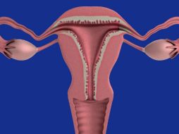 La endometriosis es una enfermedad crónica e inflamatoria. Pixabay.