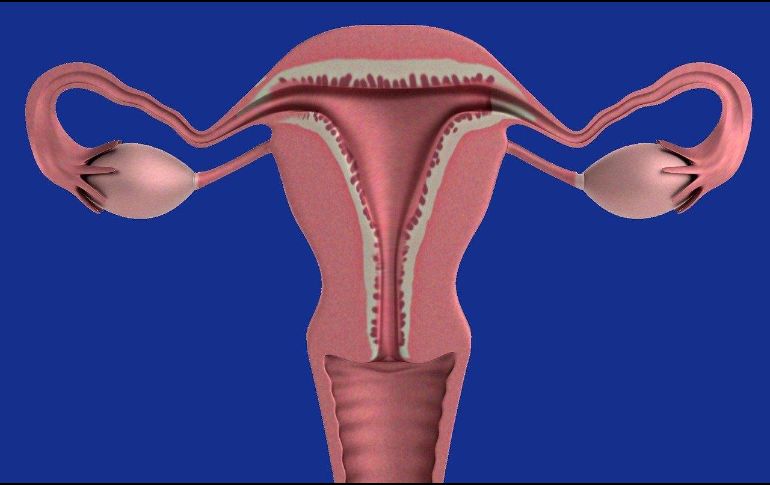 La endometriosis es una enfermedad crónica e inflamatoria. Pixabay.