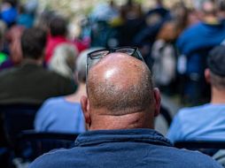 La calvicie, remarca, alude a la caída del cabello excesiva por lo que las acciones de las personas al respecto suelen ser variadas. Pixabay