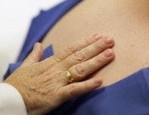 Es importante dar a conocer que esta enfermedad de la piel no es contagiosa. AFP / ARCHIVO
