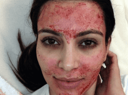 Kim Kardashian compartió en redes haber usado esta técnica. INSTAGRAM