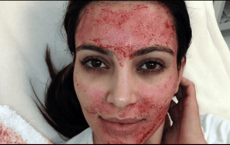 Kim Kardashian compartió en redes haber usado esta técnica. INSTAGRAM