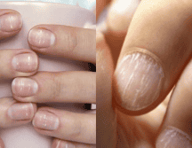 Las estrías en las uñas o uñas rayadas son más comunes de lo que se cree, ¿pero sabes por qué aparecen? Aquí te lo explicamos. ESPECIAL