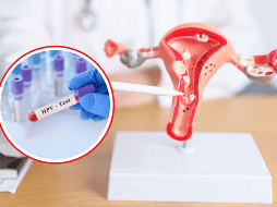Aunque el VPH puede ser asintomático en muchos casos, estar alerta a los signos y síntomas mencionados y buscar atención médica adecuada puede ayudar en la detección temprana y en la prevención de complicaciones asociadas con esta infección viral común. CANVA