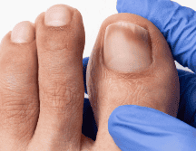 Los hongos en la piel y las uñas pueden ser comunes y son tratables. ESPECIAL