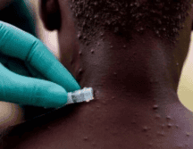 El pasado 11 de julio, la OMS alertó de que el virus de mpox sigue transmitiéndose a nivel mundial. EFE/ ARCHIVO