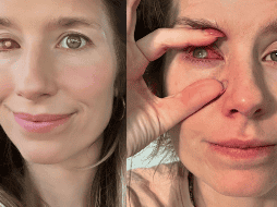 Debido a su condición, a Prochnow, madre de un niño, le indujeron el parto a las 37 semanas de embarazo para iniciar el tratamiento oral y evitar la pérdida total del ojo. 
 INSTAGRAM/@rachelprochnow